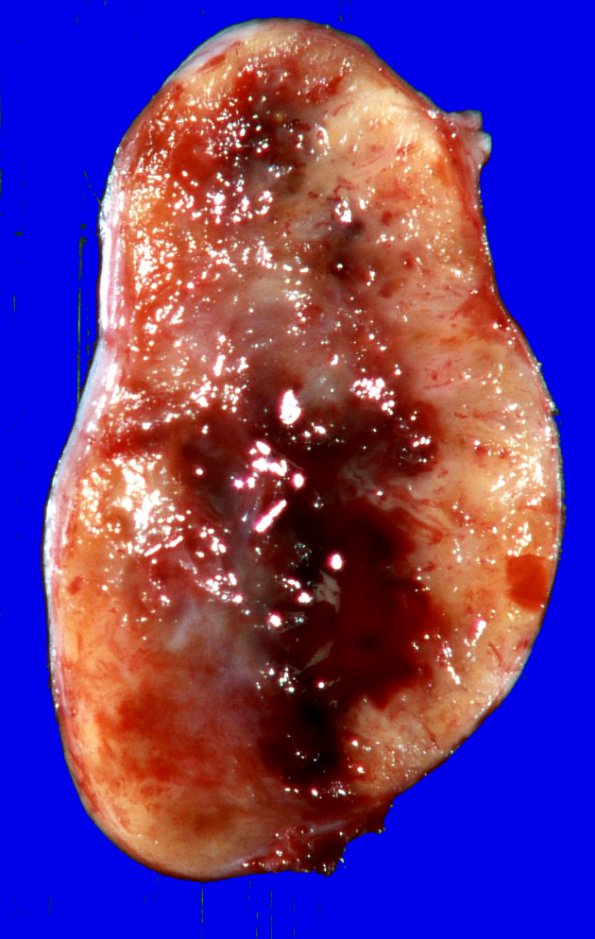 1L2 Schwannoma-Gross images (Case 1L) 2