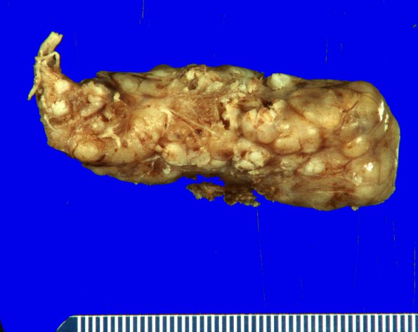 20A1 Schwannoma with whorls (Case 20) _1