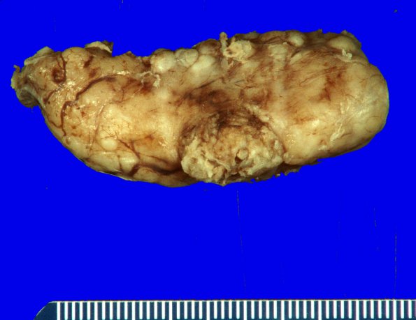 20A2 Schwannoma with whorls (Case 20) _2