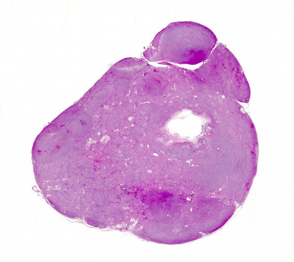 20B1 Schwannoma w whorls (Case 20) 1 H&E WM