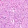 20B2 Schwannoma w whorls (Case 20) H&E 6.jpg