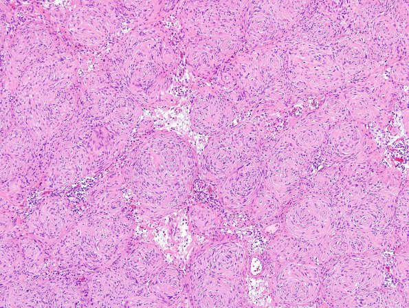 20B2 Schwannoma w whorls (Case 20) H&E 6.jpg