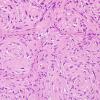 20B3 Schwannoma w whorls (Case 20) H&E 4.jpg