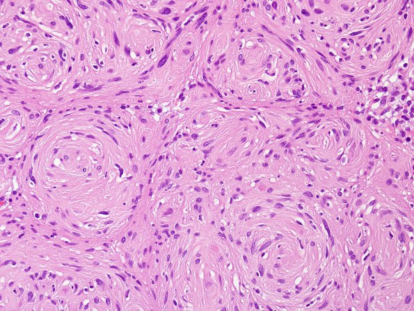 20B3 Schwannoma w whorls (Case 20) H&E 4.jpg