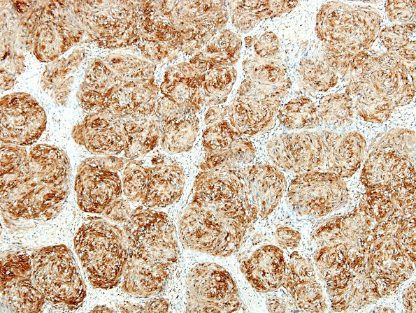 20C2 Schwannoma w whorls (Case 20) S100 1.jpg