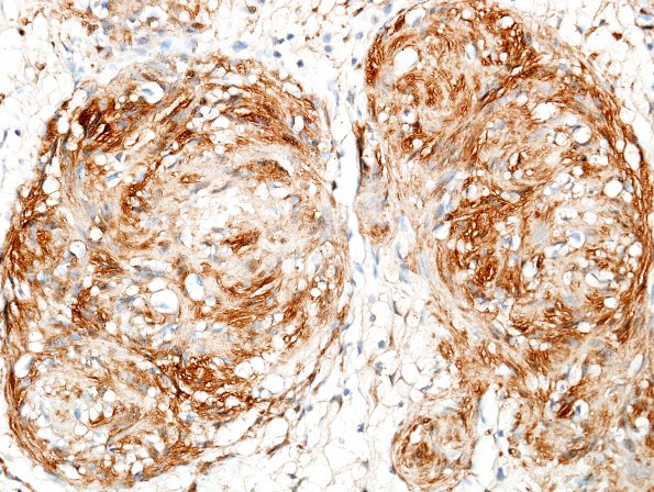 20C3 Schwannoma w whorls (Case 20) S100 4.jpg