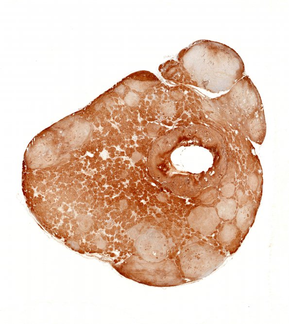 20D1 Schwannoma w whorls (Case 20) 1 Coll IV WM