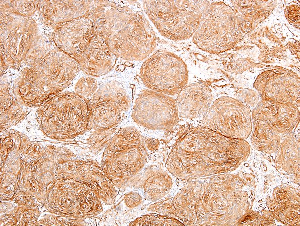 20D2 Schwannoma w whorls (Case 20) Coll IV 3.jpg