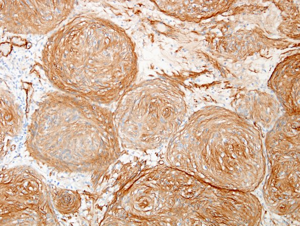 20D3 Schwannoma w whorls (Case 20) Coll IV 2.jpg