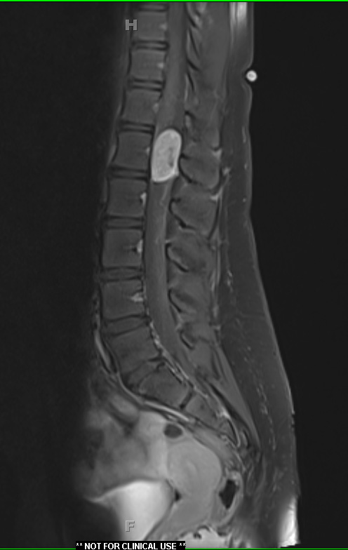 21A1 Schwannoma, 12 yo girl (Case 21) T1 W 2 - Copy (2)