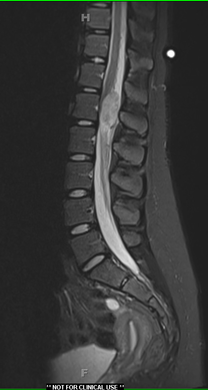 21A2 Schwannoma, 12 yo girl (Case 21) T2 2 - Copy