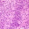 21B1 Schwannoma, 12yo girl (Case 21) H&E 3.jpg