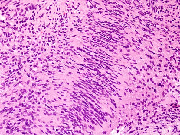 21B1 Schwannoma, 12yo girl (Case 21) H&E 3.jpg