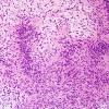 21B2 Schwannoma, 12yo girl (Case 21) H&E 1.jpg