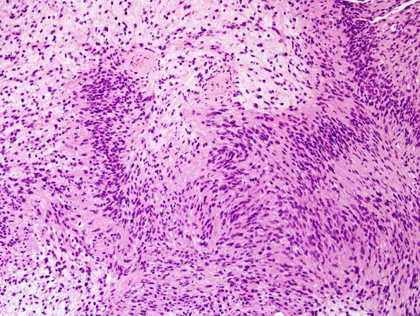 21B2 Schwannoma, 12yo girl (Case 21) H&E 1.jpg