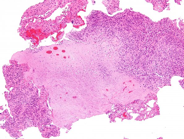 21B3 Schwannoma, 12yo girl (Case 21) H&E 10X 3