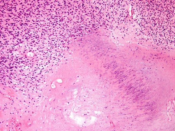 21B4 Schwannoma, 12yo girl (Case 21) H&E 5.jpg