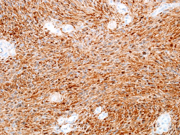 21C Schwannoma, 12yo girl (Case 21) S100 1.jpg