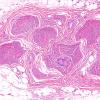 22A1 Schwannoma, intraneural (Case 22) H&E 1