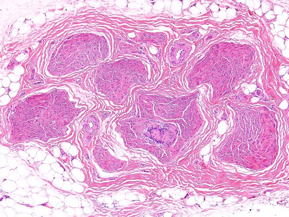 22A1 Schwannoma, intraneural (Case 22) H&E 1