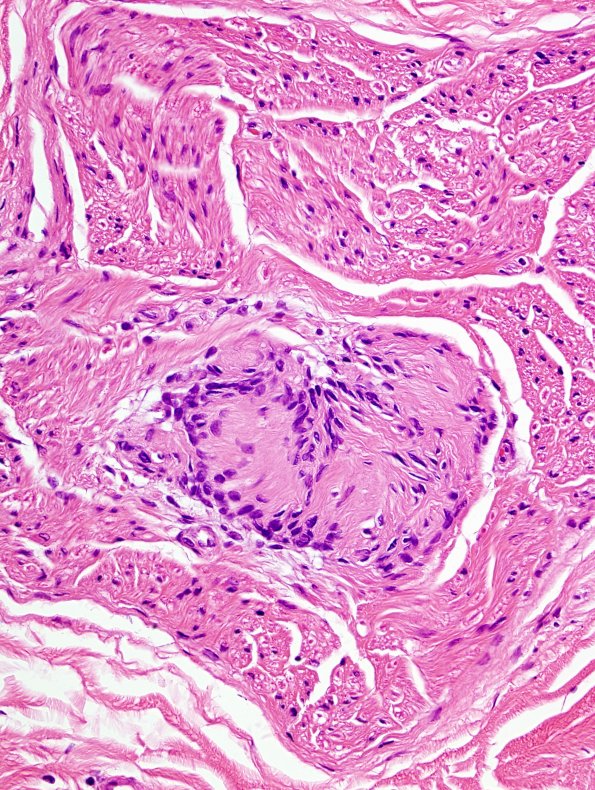 22A2 Schwannoma, intraneural (Case 22) H&E 3