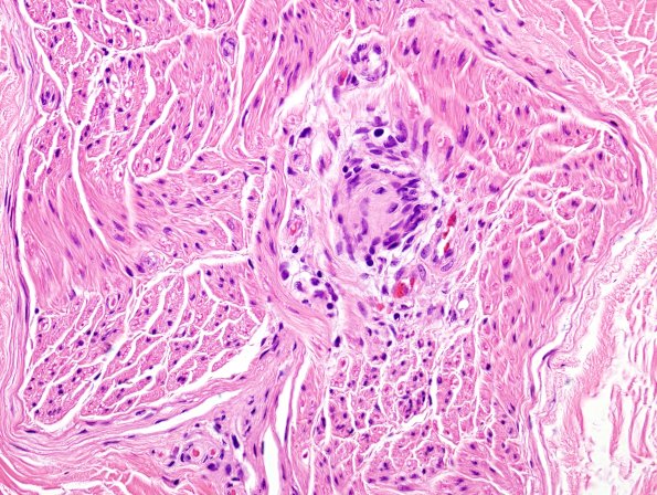 22A3 Schwannoma, intraneural (Case 22) H&E 4