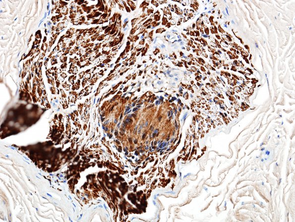 22B Schwannoma, intraneural (Case 22) S100