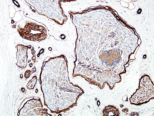 22C1 Schwannoma, intraneural (Case 22) Coll IV 2