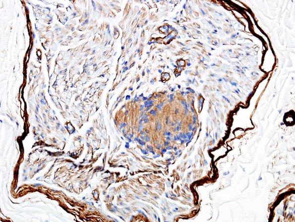 22C2 Schwannoma, intraneural (Case 22) Coll IV 1