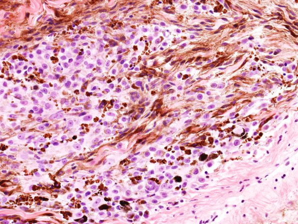 23A2 Schwannoma, melanotic (Case 23) H&E 3