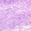 23B1 Schwannoma, melanotic (Case 23) Melanin Blanch 2