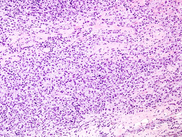 23B1 Schwannoma, melanotic (Case 23) Melanin Blanch 2