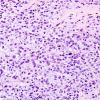 23B2 Schwannoma, melanotic (Case 23) Melanin Blanch 1