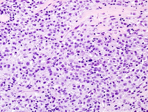 23B2 Schwannoma, melanotic (Case 23) Melanin Blanch 1