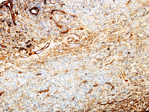 23C1 Schwannoma, melanotic (Case 23) Coll IV 2