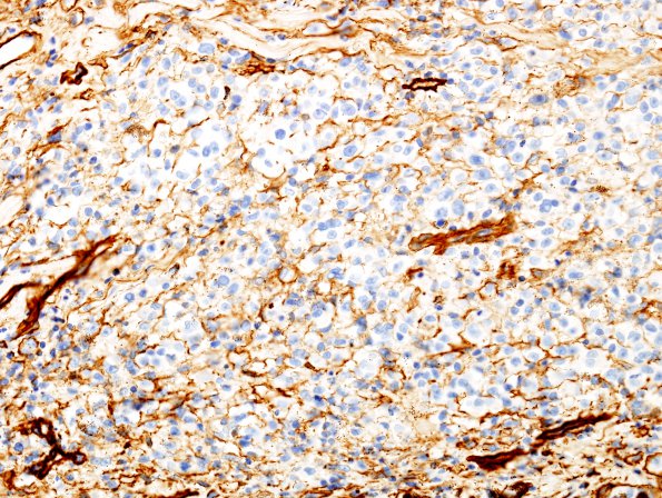 23C2 Schwannoma, melanotic (Case 23) Coll IV 1