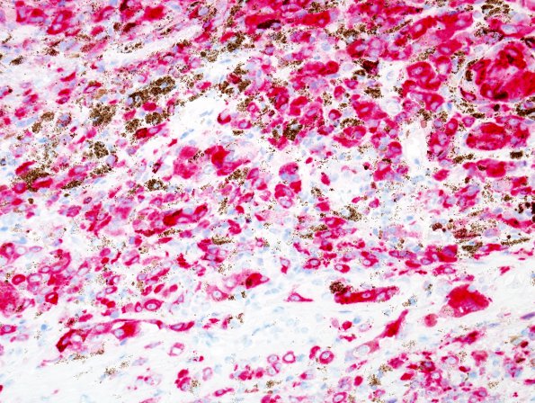 23D Schwannoma, melanotic (Case 23) Melan-A 1