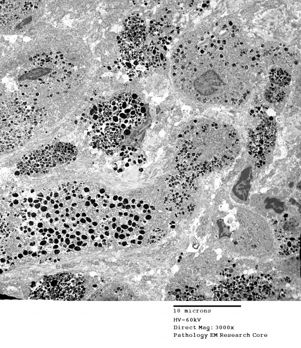 23F1 Schwannoma, melanotic (Case 23) EM 3 - Copy