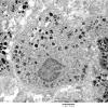 23F2 Schwannoma, melanotic (Case 23) EM 6 - Copy