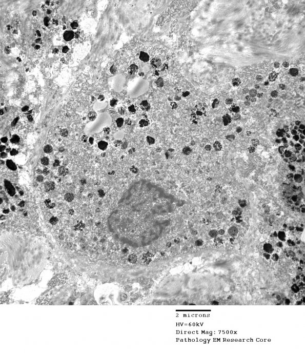 23F2 Schwannoma, melanotic (Case 23) EM 6 - Copy