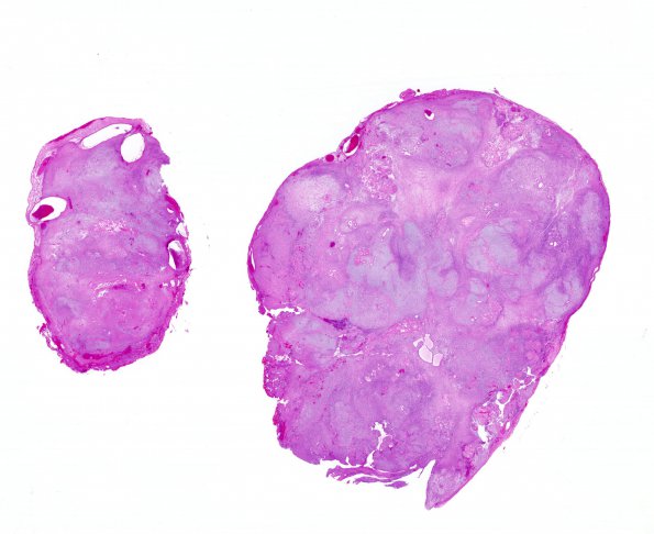 24A1 Schwannoma, myxoid (Case 24) 1 H&E WM