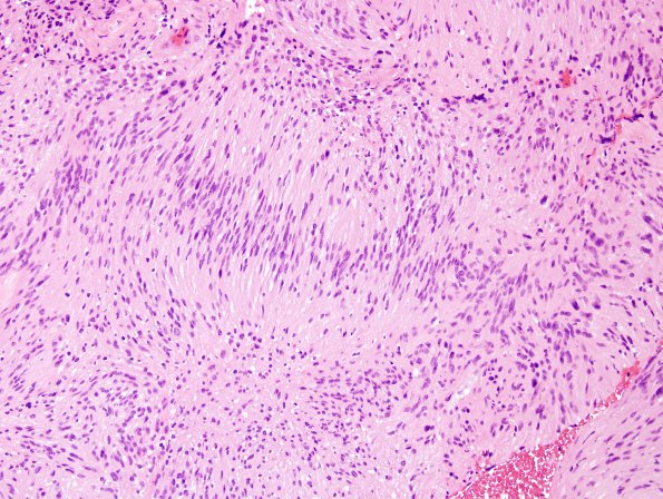 24A2 Schwannoma, myxoid (Case 24) H&E 5.jpg