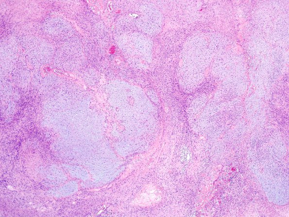 24A3 Schwannoma, myxoid (Case 24) H&E 1.jpg