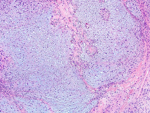 24A4 Schwannoma, myxoid (Case 24) H&E 2.jpg