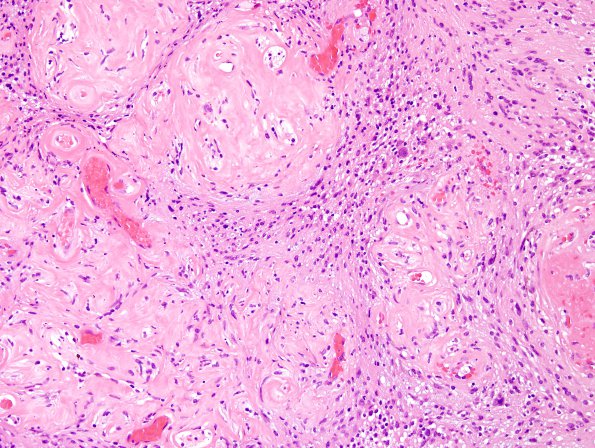 24A5 Schwannoma, myxoid (Case 24) H&E 7.jpg