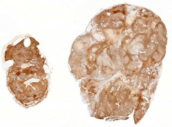 24B1 Schwannoma, myxoid (Case 24) 1 S100 WM