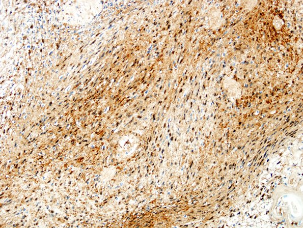 24B2 Schwannoma, myxoid (Case 24) S100 2.jpg