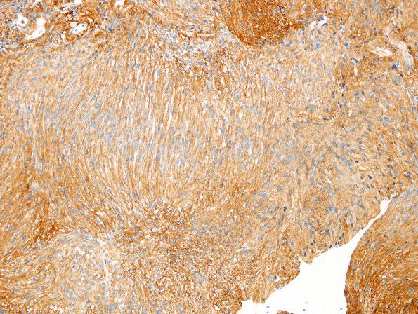 24C2 Schwannoma, myxoid (Case 24) Coll IV 3.jpg