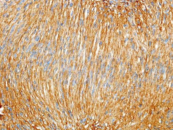 24C3 Schwannoma, myxoid (Case 24) Coll IV 1.jpg