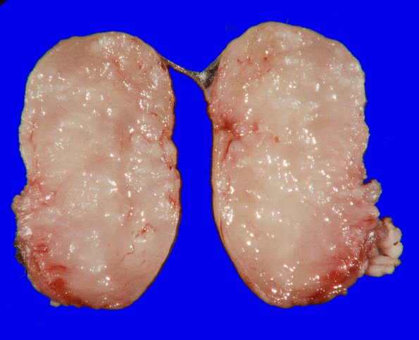 25A Schwannoma, nodular (Case 25) 4